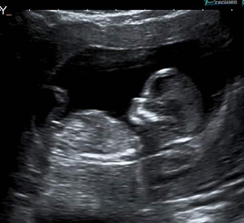 An ultrasound photo of a baby